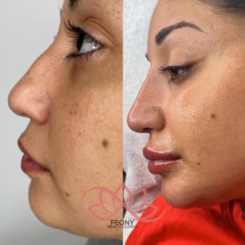 Fillers Peony beauty